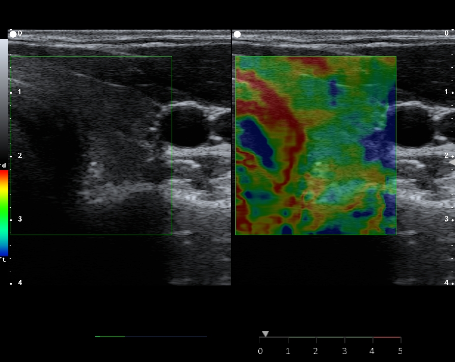甲状腺弹性成像